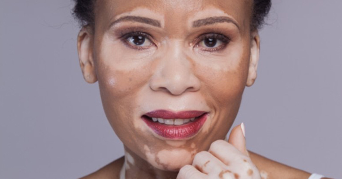 L’actrice Leti Khumalo son combat contre le vitiligo — Queen MAFA
