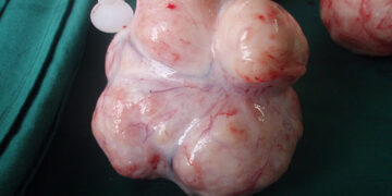 Santé de la reproduction : Tout savoir sur les fibromes