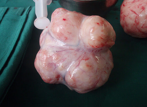 Santé de la reproduction : Tout savoir sur les fibromes