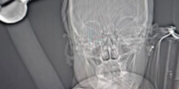 Centre hospitalier régional de Ouahigouya : Une patiente opérée d’une pioche à la tête