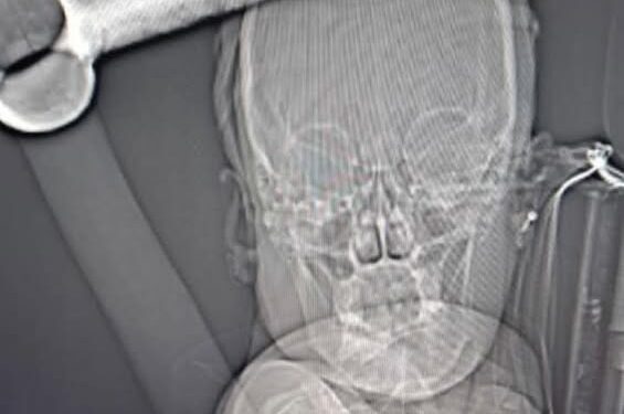 Centre hospitalier régional de Ouahigouya : Une patiente opérée d’une pioche à la tête