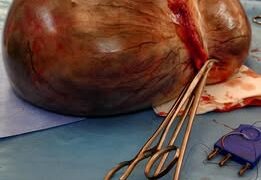 Dédougou : intervention réussie d’un kyste ovarien de 6.9 kg