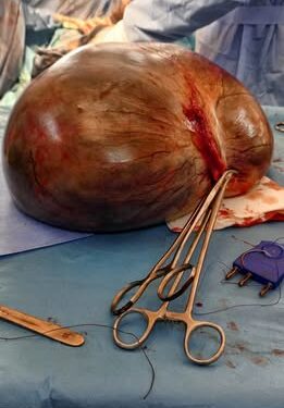 Dédougou : intervention réussie d’un kyste ovarien de 6.9 kg