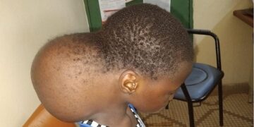 Burkina Faso:  Kadi, une élève , opérée d’une tumeur de 4 kilos grâce à une Institutrice