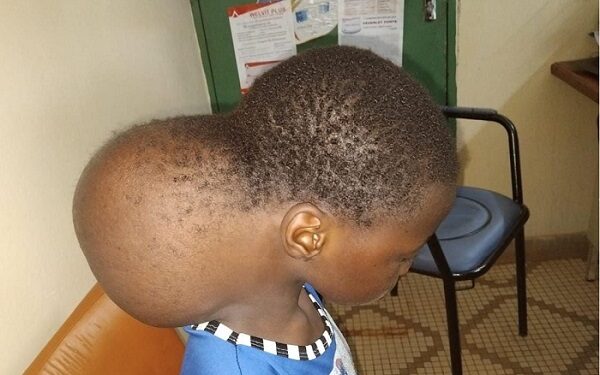 Burkina Faso:  Kadi, une élève , opérée d’une tumeur de 4 kilos grâce à une Institutrice