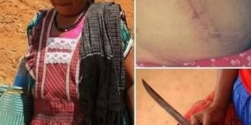 La césarienne la plus folle de l’histoire… une femme l’a pratiquée sur elle-même !