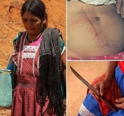 La césarienne la plus folle de l’histoire… une femme l’a pratiquée sur elle-même !